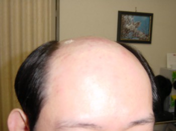 男性かつら・装着前