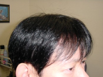 男性かつら・装着後