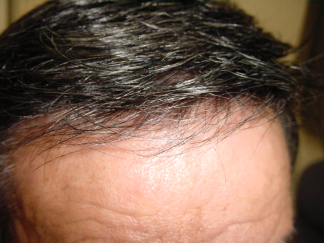 男性かつら・フロント