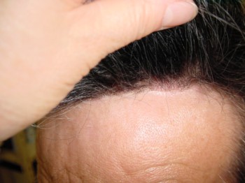 男性かつら・生え際