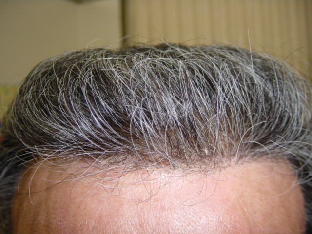 男性かつらの生え際